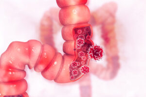 colon cancer